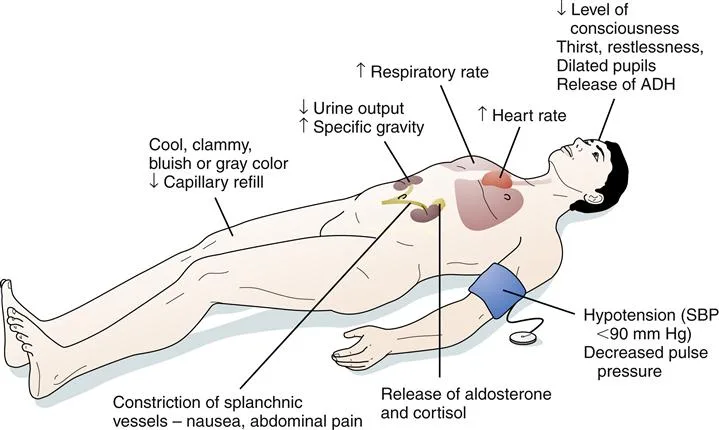 Surgical Shock Clinical Features