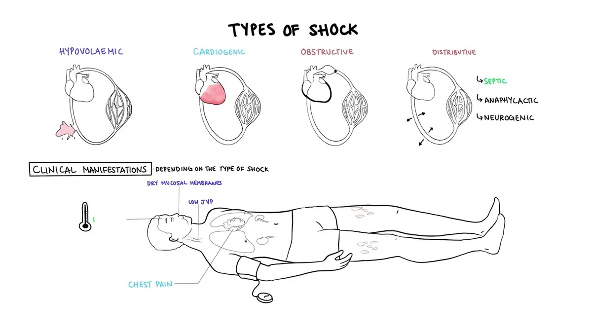 Surgical Shock Types