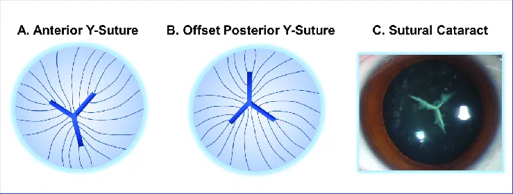 Sutural Cataract
