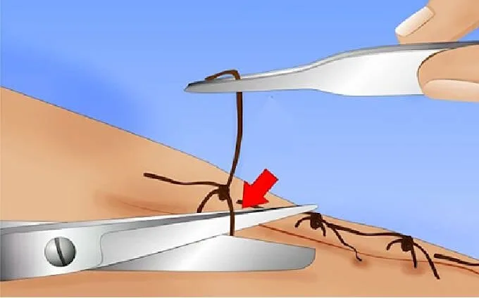 Suture Removal Guidelines 1 E1742278405306