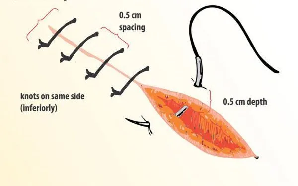 Suturing
