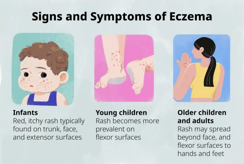 Symptoms Of Atopic Eczema Vary Across Different Age Groups 1