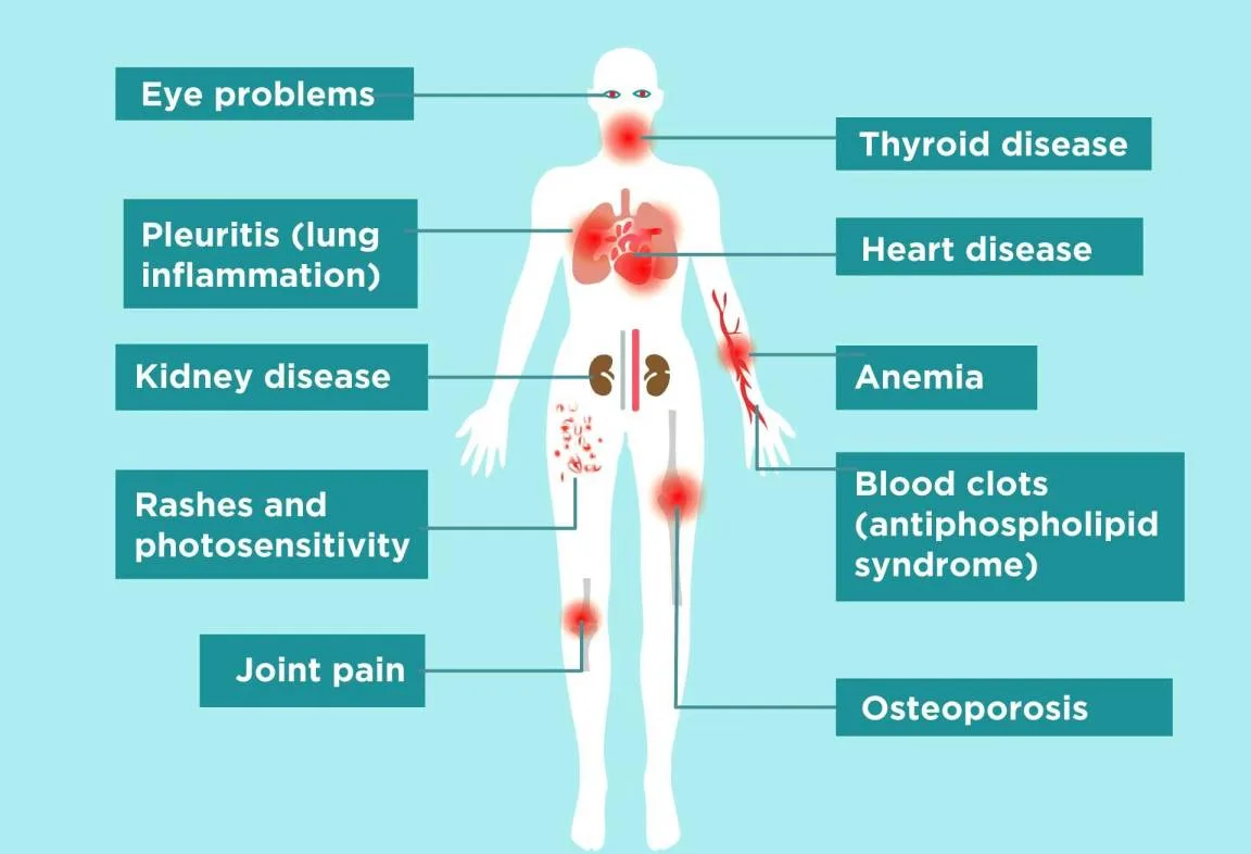 Systemic Lupus Erythematosus COMPLICATIONS 2