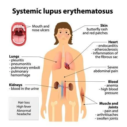 Systemic Lupus Erythematosus Signs And Symptoms Unmeb