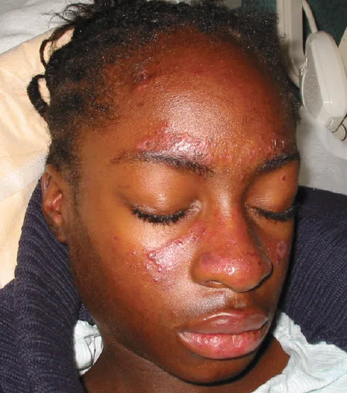 Systemic Lupus Erythematosus