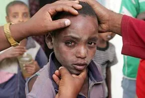 TRACHOMA 51985c48