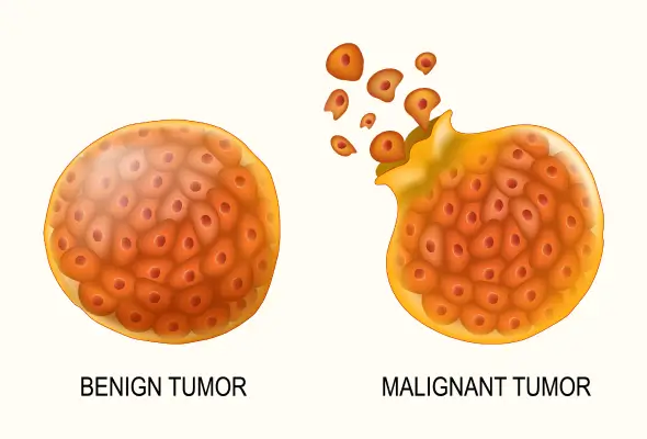 TUMORS NEOPLASMSTUMORS NEOPLASMS