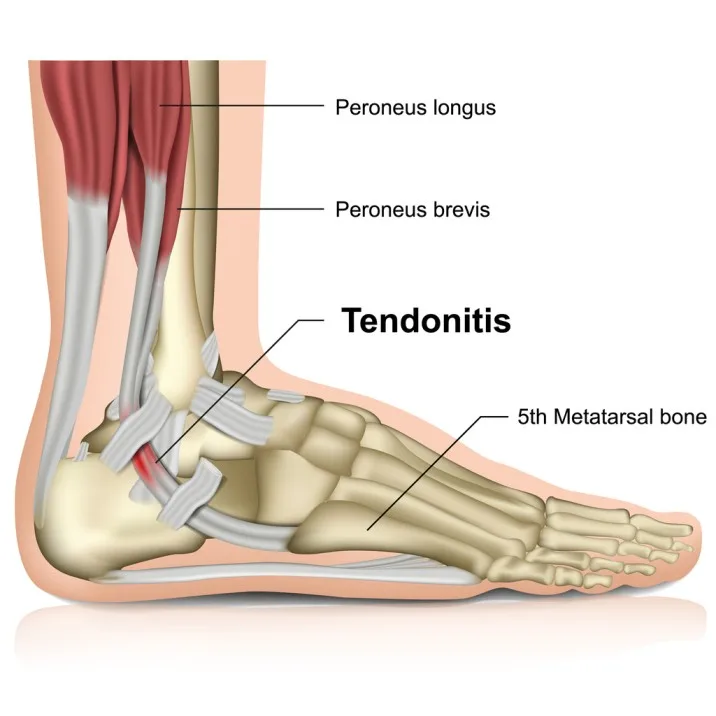 Tendonitis