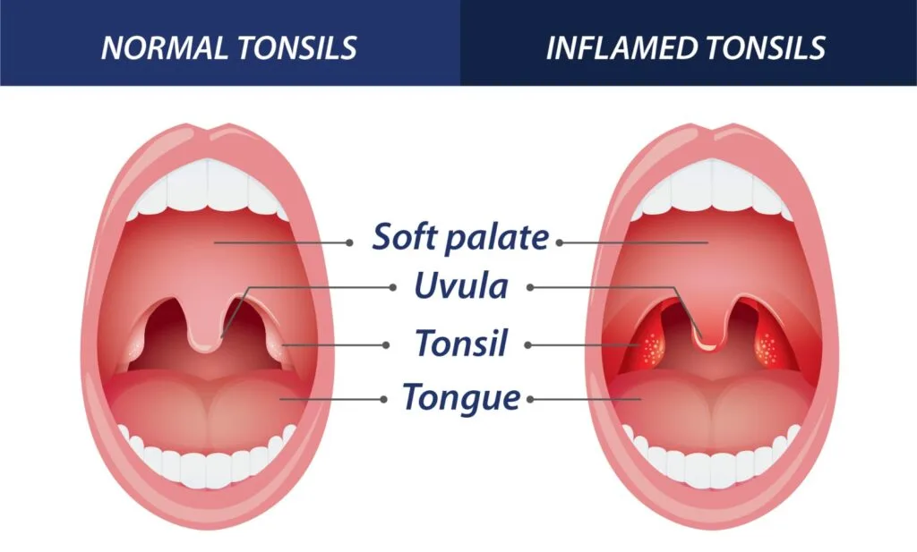 Tonsillitis