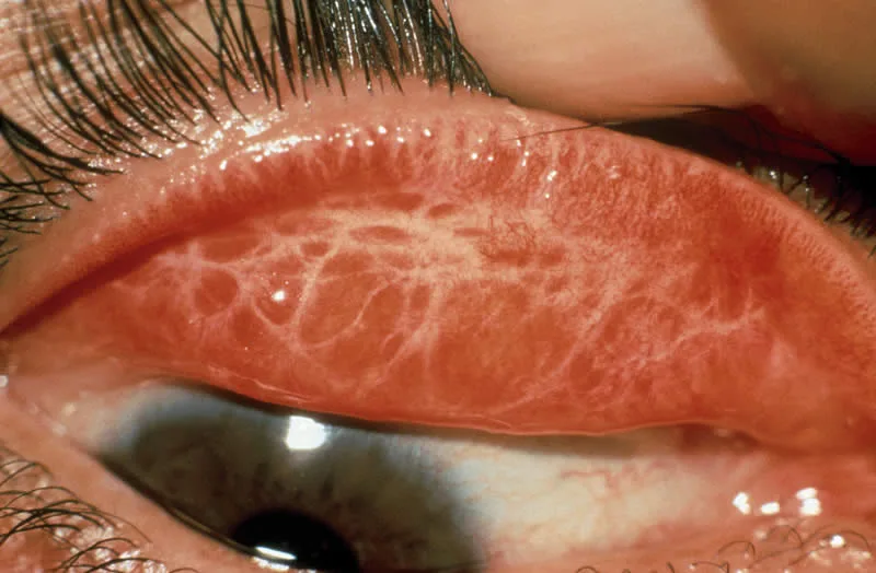 Trachoma