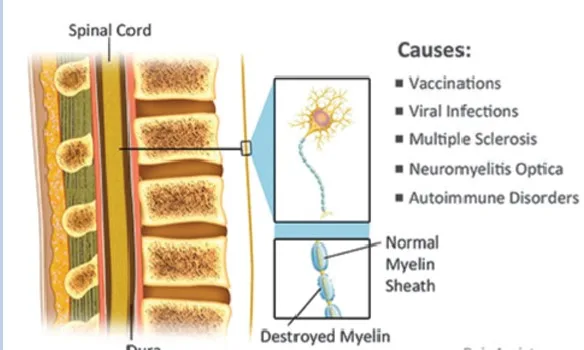 Transverse Myelitis
