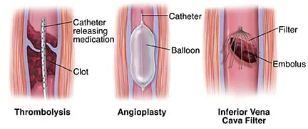 Treatment Of A Thrombus 1