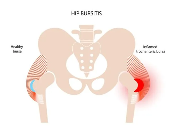 Trochanteric Bursitis