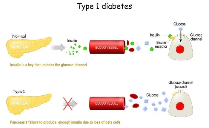 Type 1 Diabetes Mellitus 1 E1703262802761