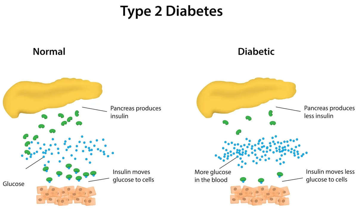 Type 2 Diabetes Mellitus 1