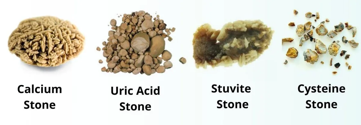 Type Of Kidney Stone