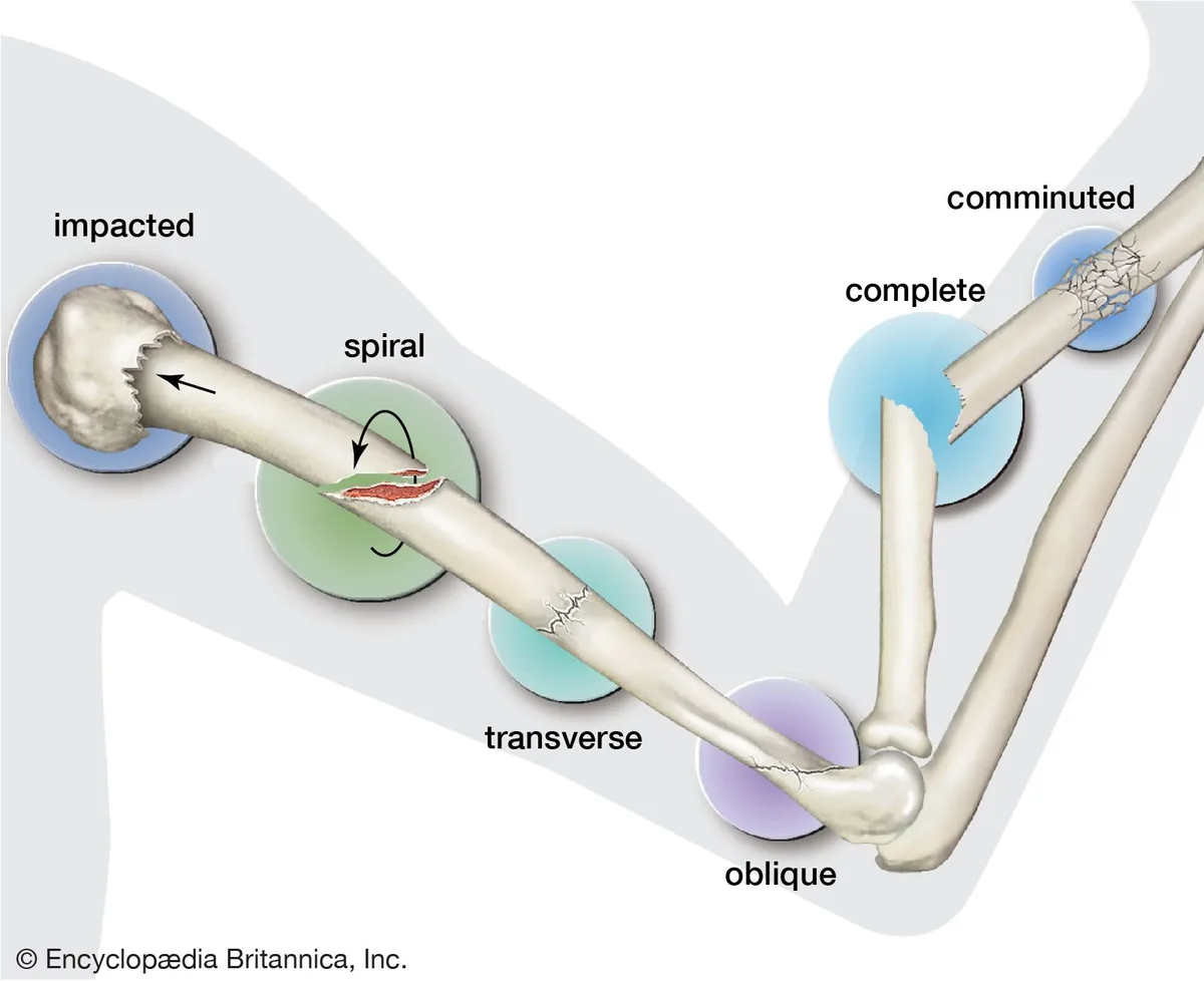 Types Fractures Bones