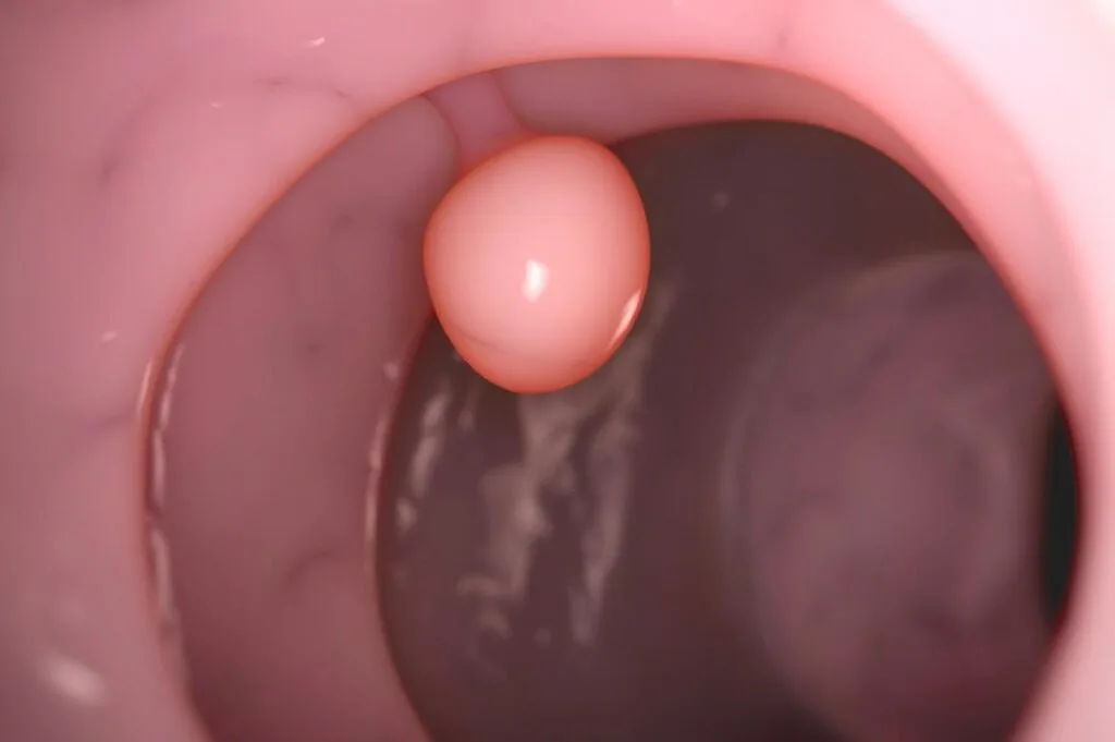Types Of Cervical Polyps