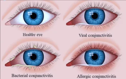Types Of Conjunctivitis Pink Eye 2