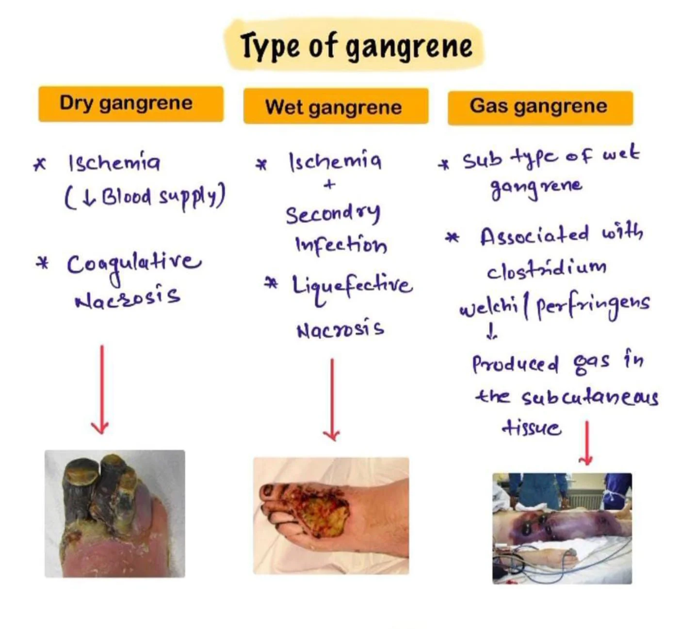 Types Of Gangrene