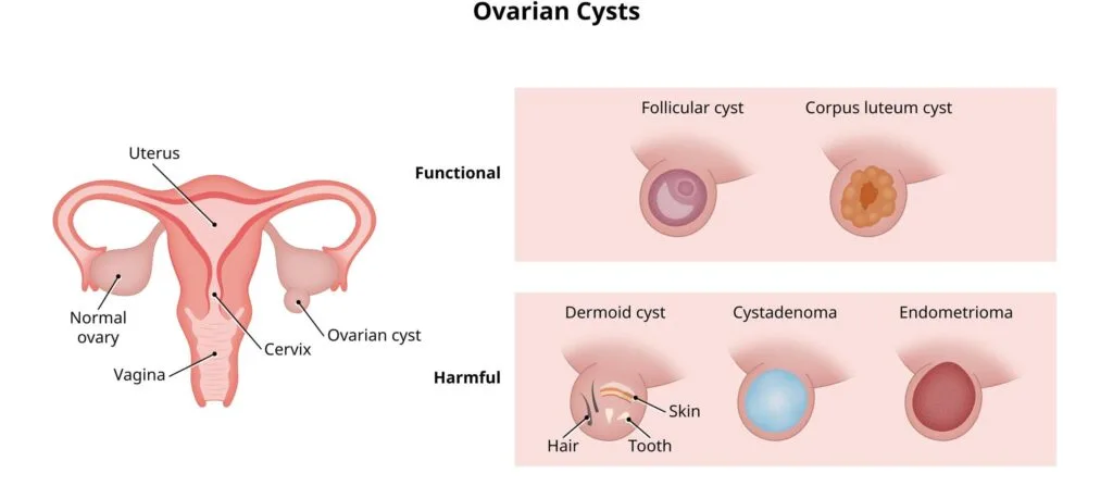 Types Of Ovarian Cysts 1 E1733385593818