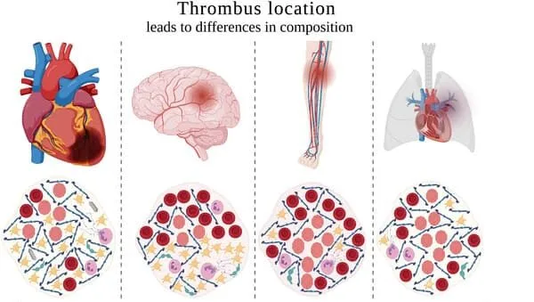 Types Of A Thrombus Classification By Location And Composition 1 E1753077104558