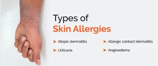 Types Of Skin Allergies