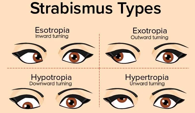 Types Of Strabismus E1708525035235
