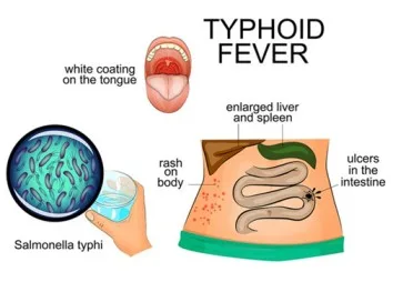Typhoid Fever Enteric Fever