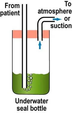 Under Water Seal Drainage 1 Bottle
