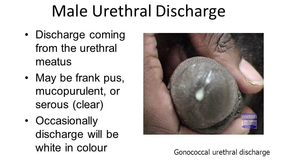 Urethral Discharge Syndrome E1707665370414