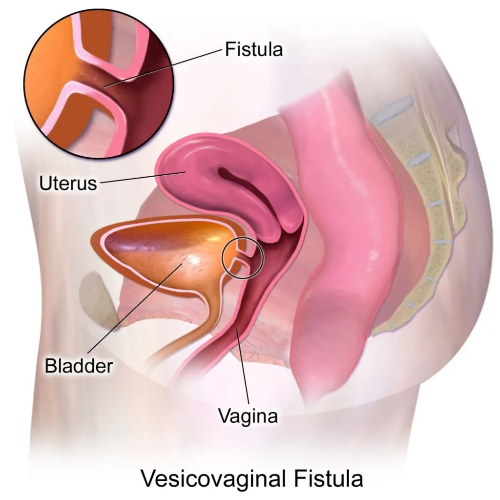 VESICO VAGINAL FISTULA