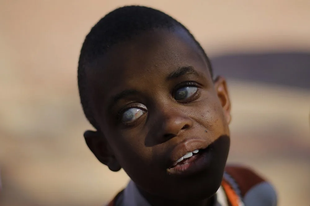 VISUAL IMPAIRMENT