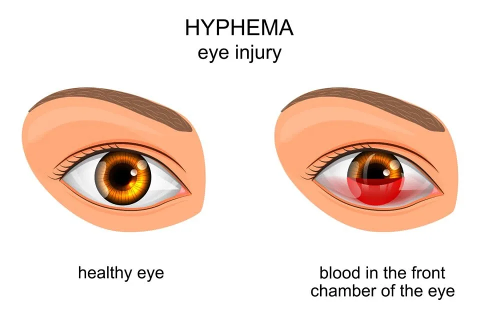 Acute Hyphema