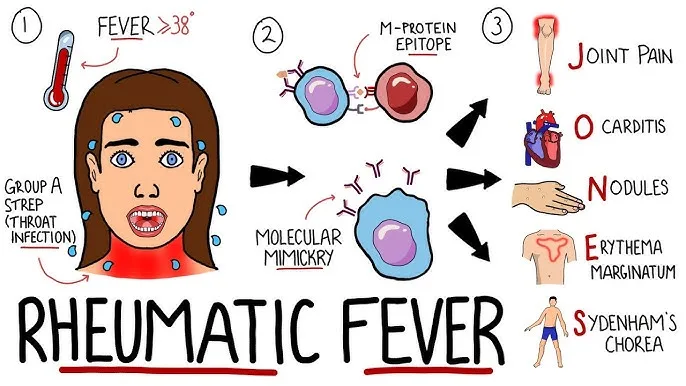 Acute Rheumatic Fever