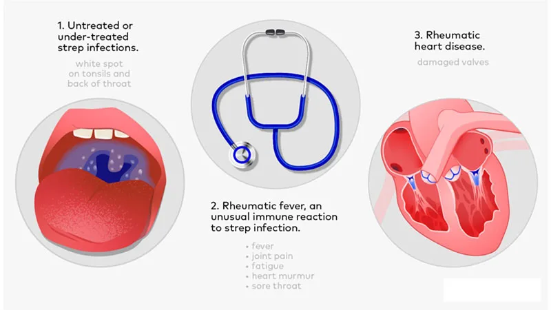 Acute Rheumatic Heart Disease