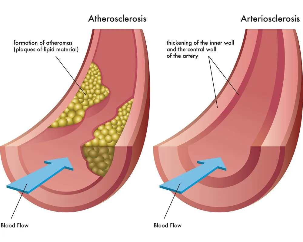 Atherosclerosis And Arteriosclerosis