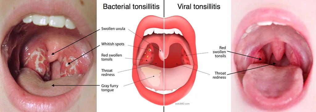 Bacterial Tonsillitis Viral Tonsillitis