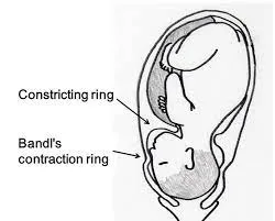 Bandals Ring