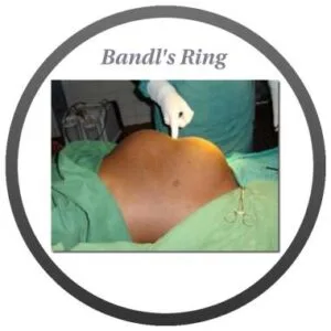 Bandalss Ring