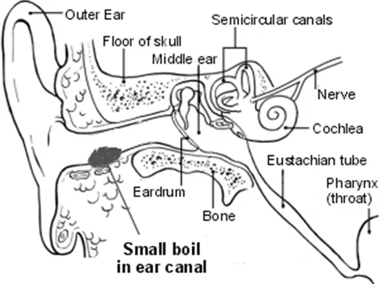 Boil Furuncle 1