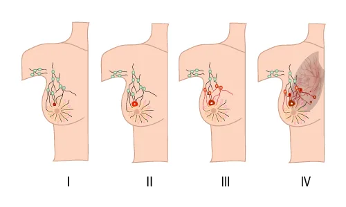 Breast Cancer Staging