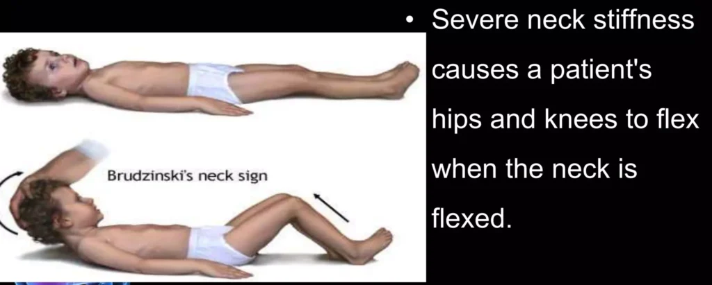 Bruds Sign Meningitis E1702982579732