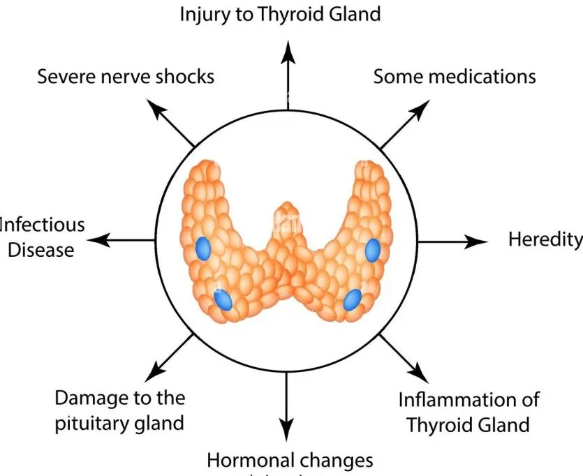 Causes Of Throtoxicosis 1 E1703396255152