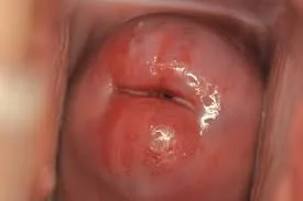 Cervical Ectropion Erosion