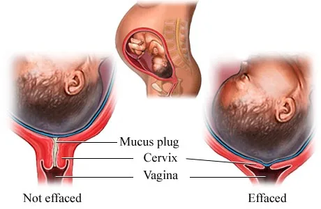 Cervical Effacement