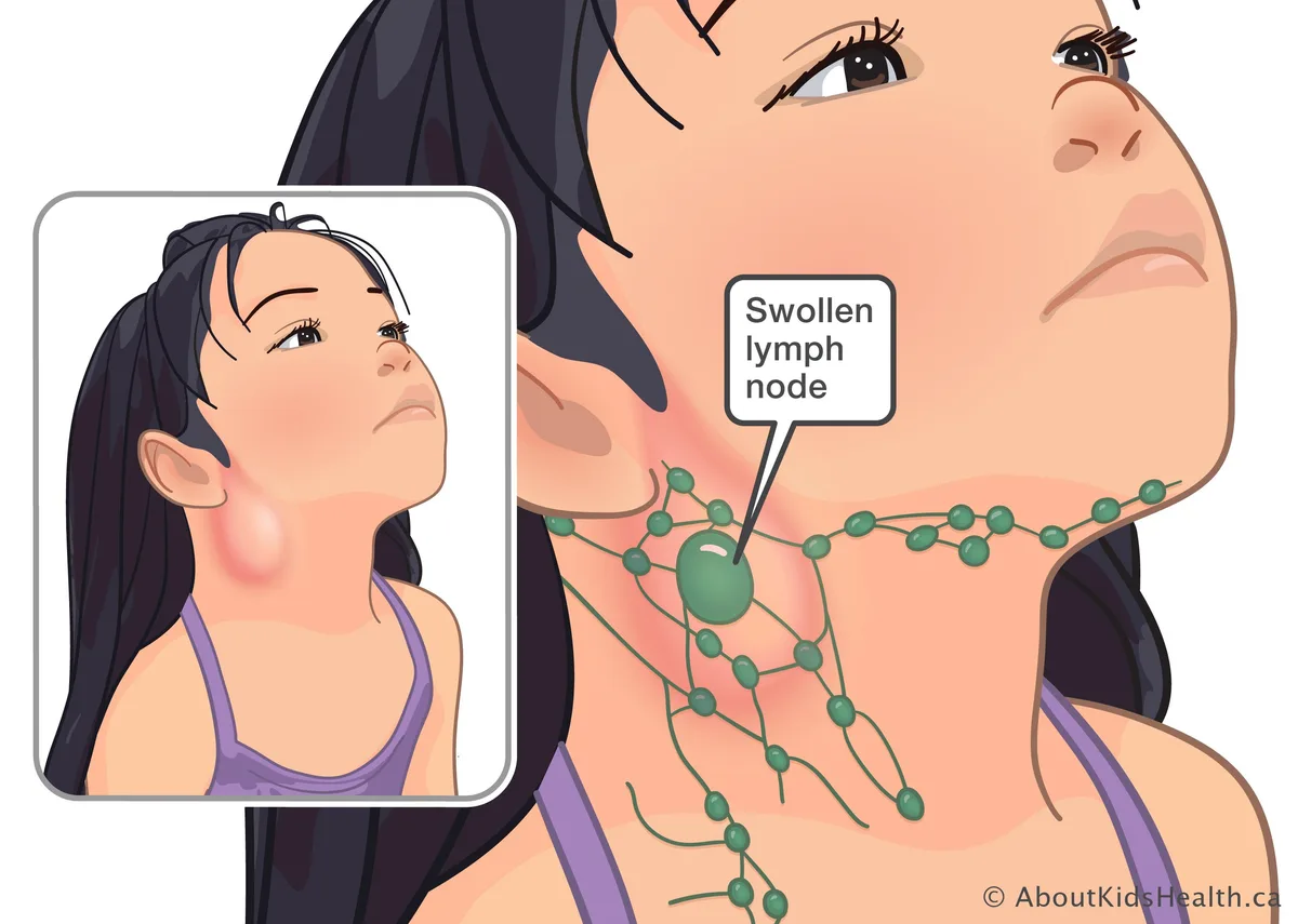 Cervical Lymphadenitis Swollen Lymph Node