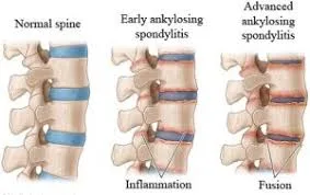 Characteristics Of Ankylosing Spondylitis