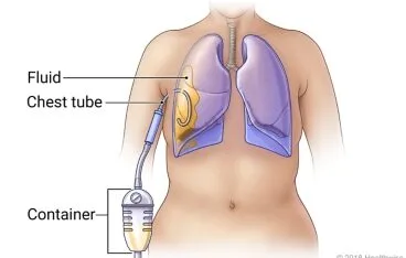 Chest Tube E1719123851291