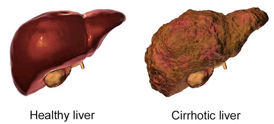 Cirrhosis Liver 1